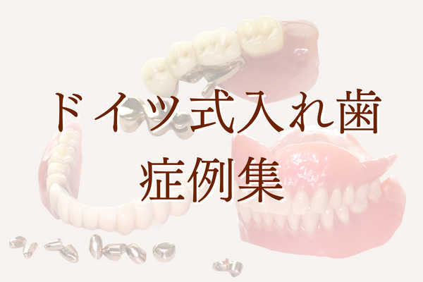 ドイツ式入れ歯・テレスコープ義歯の画像症例集 - 東京都入れ歯専門外来・このは歯科クリニック（文京区）